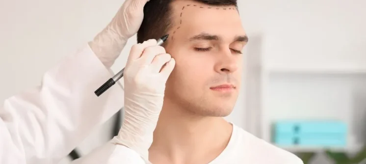 Frontal Bölge Yoğunlaştırma: Seyrek Saç İçin Kalıcı Çözüm - Maya Hair Hospital